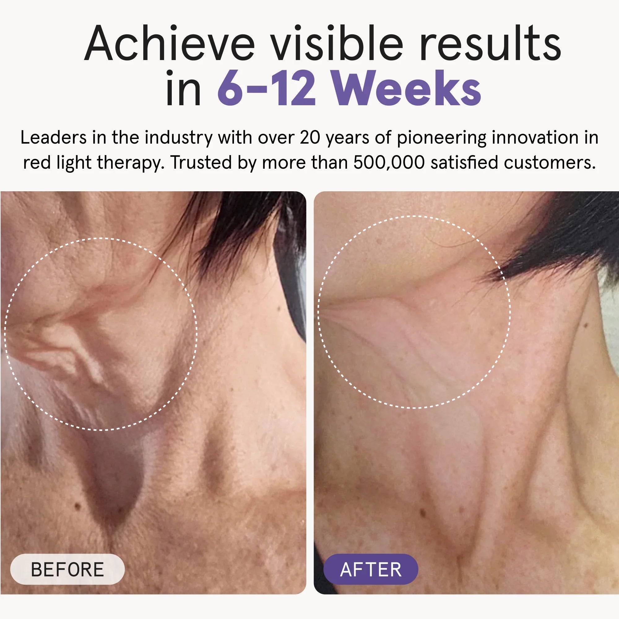 Side-by-side comparison of a woman’s profile showing visible improvements in neck skin firmness and reduced sagging after using the iRESTORE LED neck and chest mask for 6 to 12 weeks